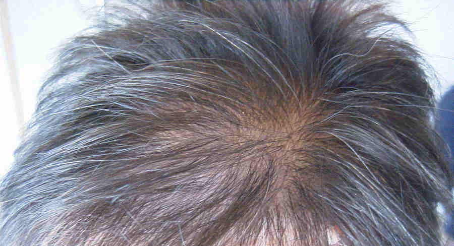 regrow hair in bald area